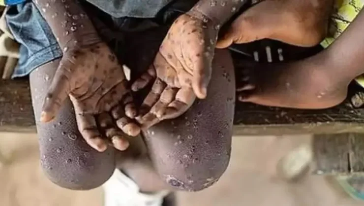 Afrika’da Maymun Çiçeği Salgını Tehdit Oluşturuyor